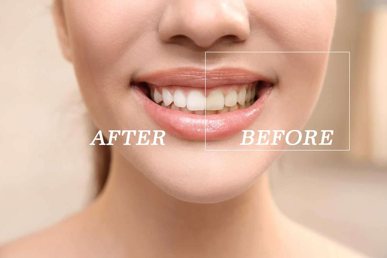 How Can You Maintain a Consistent Smile Shade with Crowns Grays?