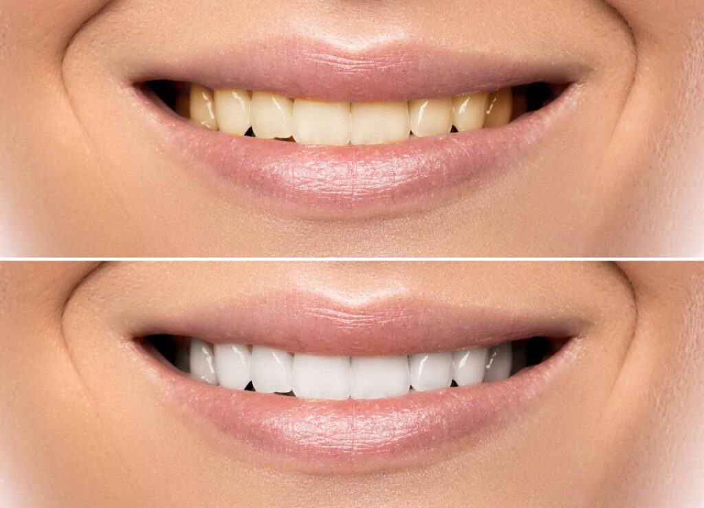 How Can You Protect Your White Smile as a Coffee Lover Grays?