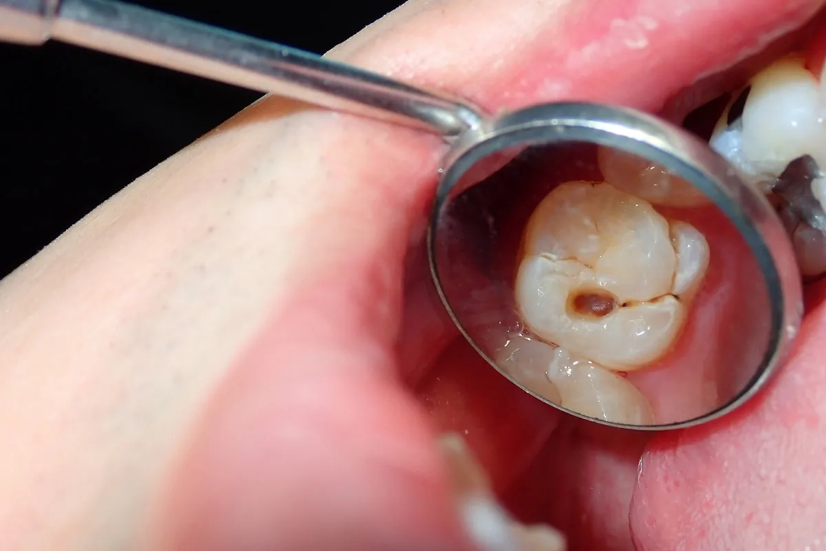 Why Do Teeth Crack? Common Causes to Know Grays