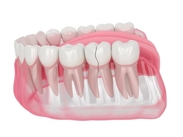 How Can You Manage Pain and Discomfort After a Root Canal Grays?