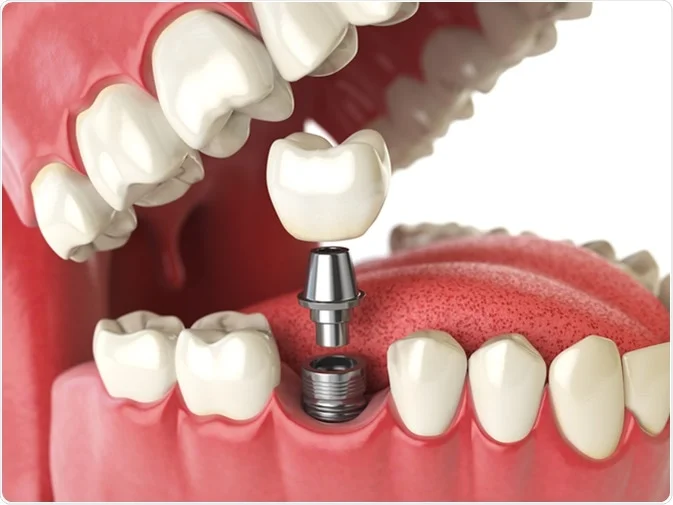 How Do I Decide Which Tooth Replacement Is Right for Me Grays?