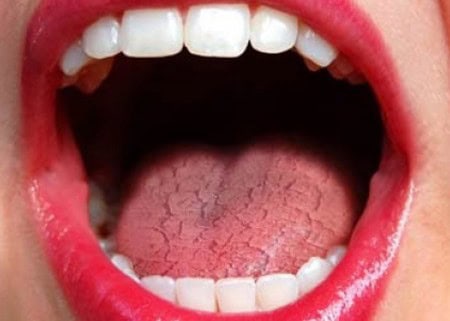 Dry Mouth and Its Role in Tooth Decay Grays