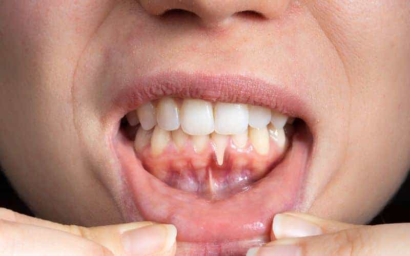 How Can Gum Disease Be Prevented Grays?