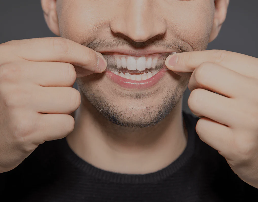 What to Consider Before Choosing a Teeth Whitening Option Grays