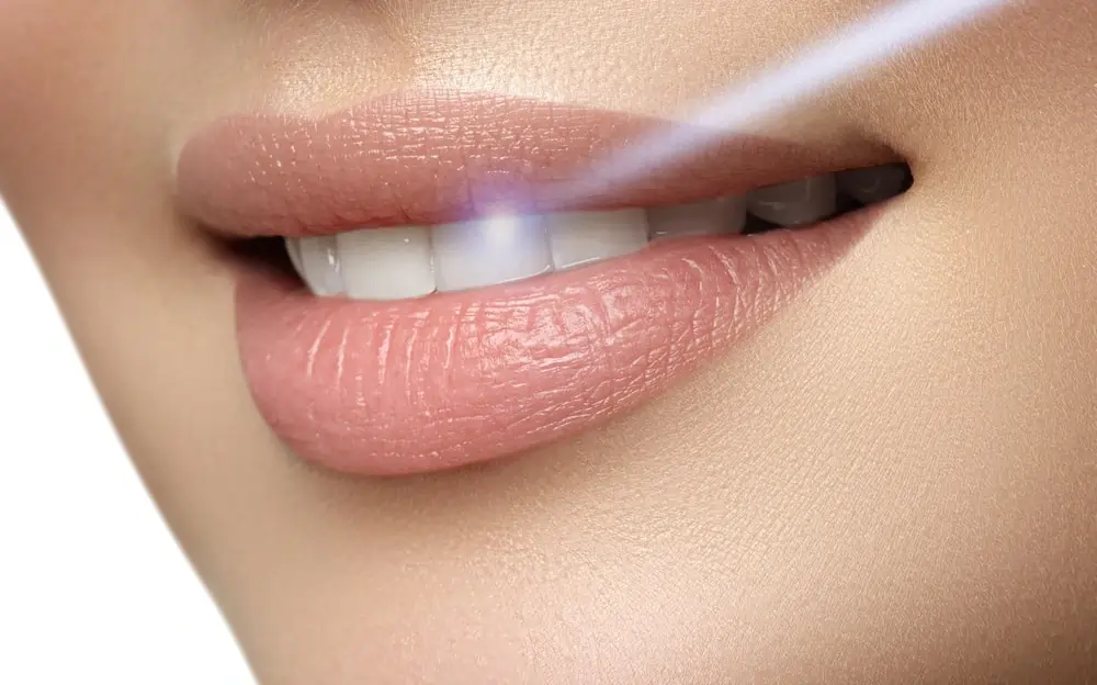 A Smarter Alternative: At-Home Laser Teeth Whitening Grays