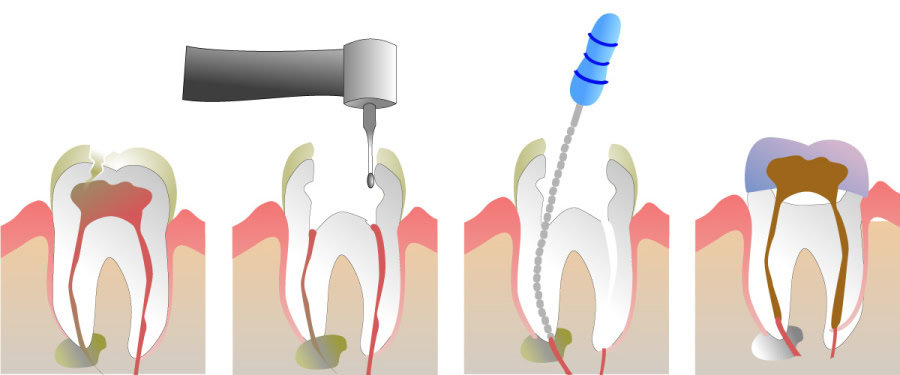 How Do You Properly Care for Your Teeth After a Root Canal Grays