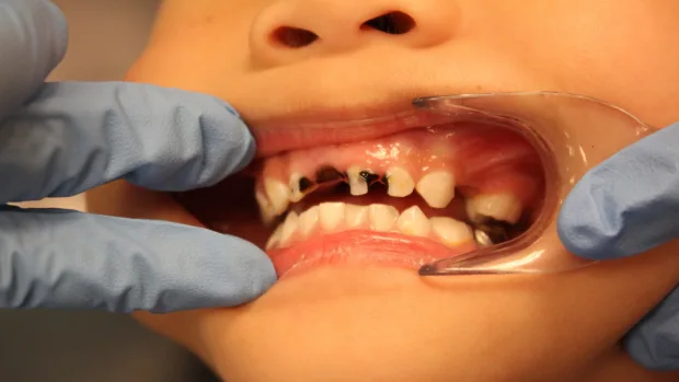 Which Foods and Drinks Cause the Most Damage to Young Smiles Grays?