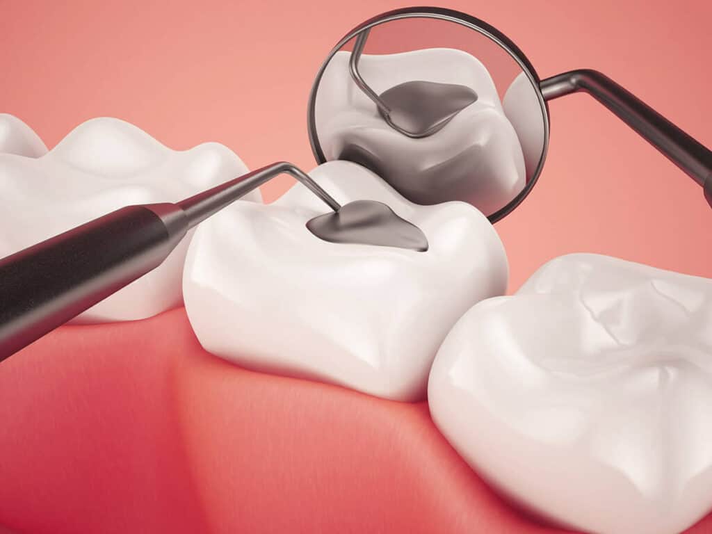 How Can You Prevent Tooth Decay Effectively Grays