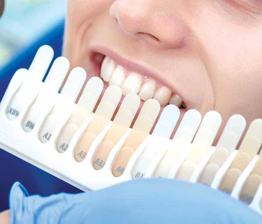 Professional vs At-Home Whitening: What You Need to Know Grays