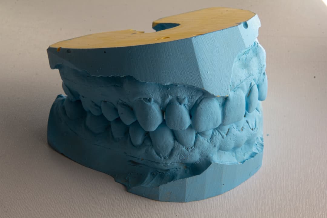 How Do Dental Implants Improve Jawbone Health and Oral Function Grays?