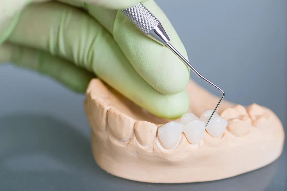 What Are the Different Types of Dental Crowns Available Grays?