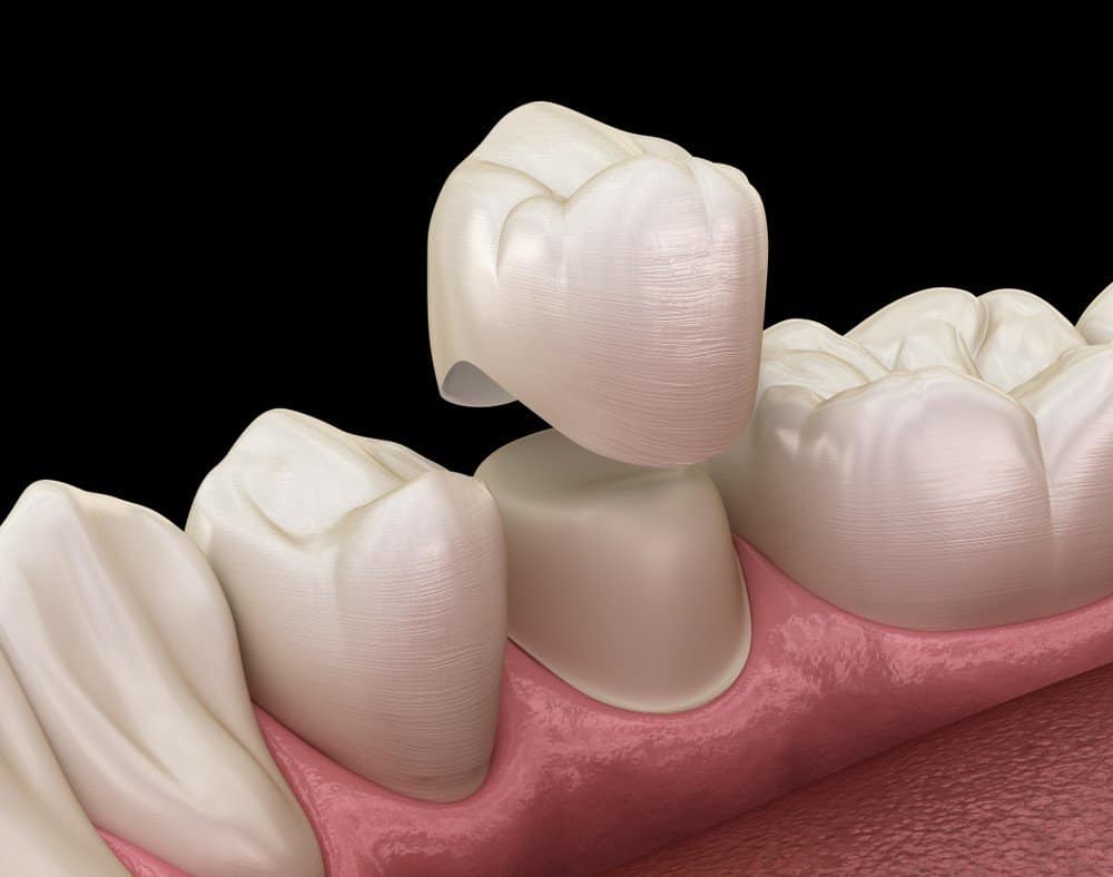 Teeth Whitening: Separating Facts from Fiction Grays