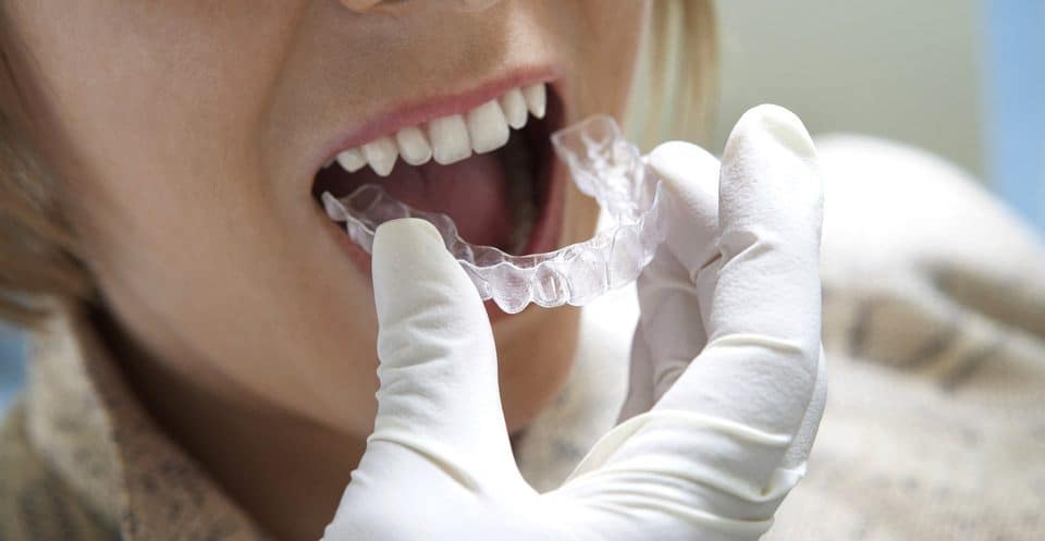 How Much Does Laser Teeth Whitening Cost Compared to Overnight Trays Grays?