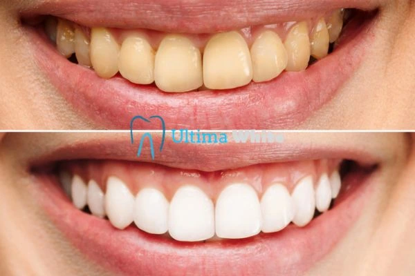 Oral Care Tips for Current and Former Smokers Grays