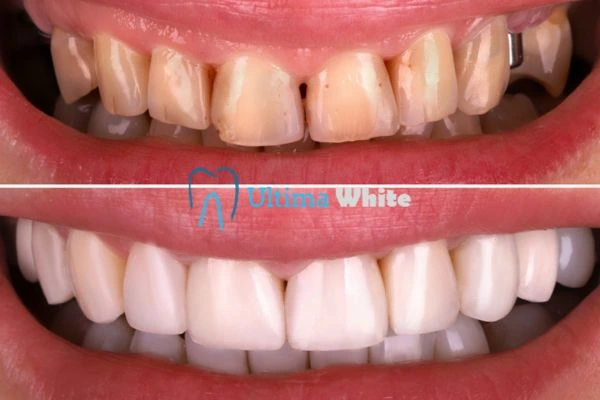 What Makes Instant Teeth Whitening Treatments So Popular Grays?
