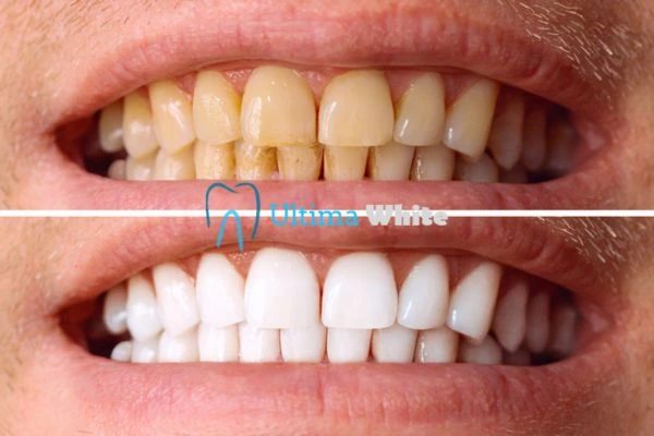 Stained Teeth and Persistent Bad Breath Grays