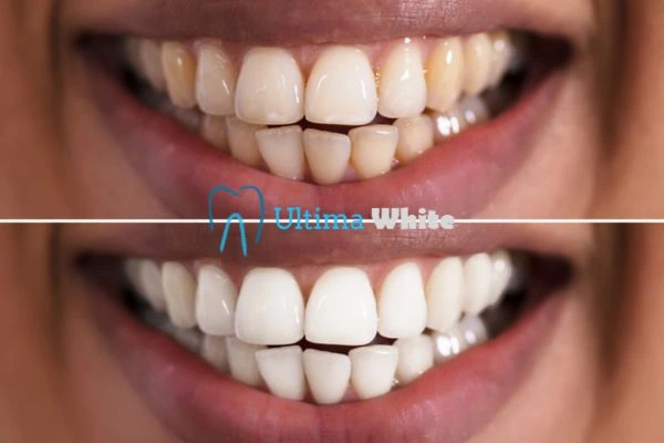 Aftercare Tips to Maintain Your New Smile Grays